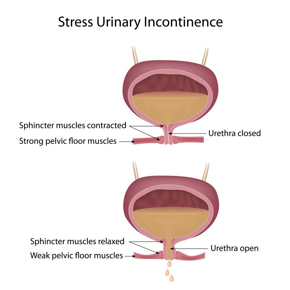 Pelvic floor stress incontinence Incontinence UK